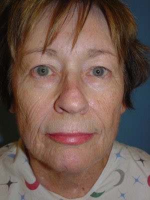 Before-Facelift