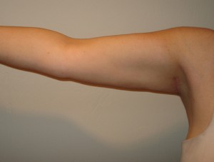 After-Liposuction