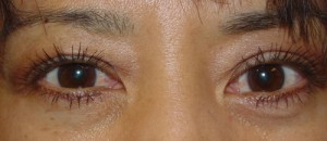 After-Lower Blepharoplasty