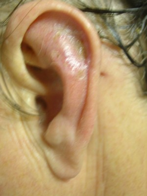 After-Ear Reconstruction