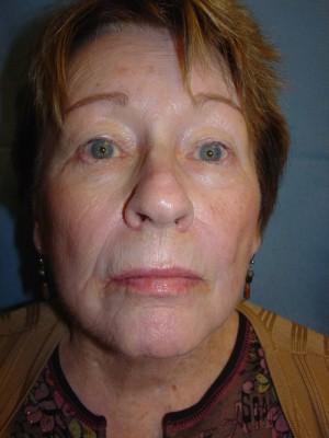 After-Facelift