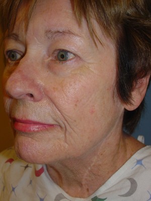 Before-Facelift