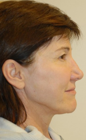 After-Liquid Facelift