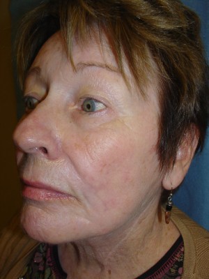 After-Facelift