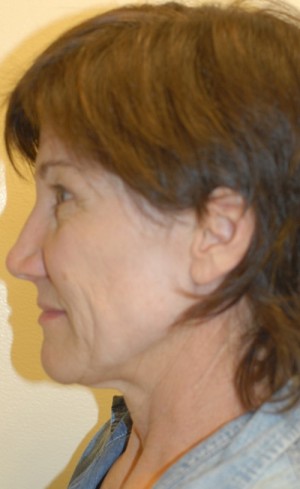 Before-Liquid Facelift