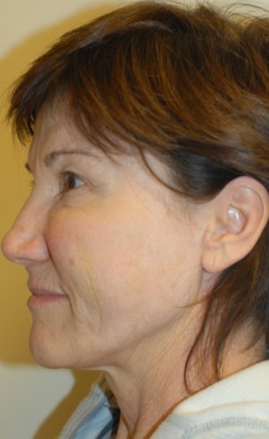 After-Liquid Facelift