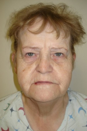 Before-Facelift
