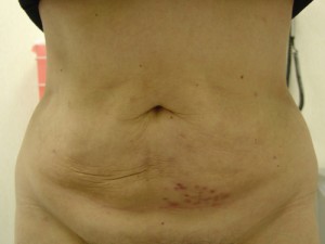 After-Liposuction