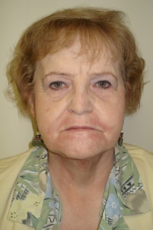 After-Facelift