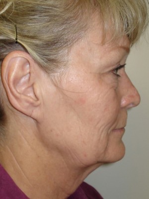 Before-Facelift