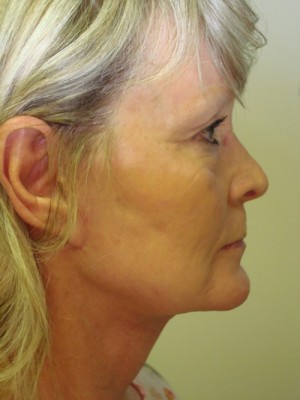After-Facelift