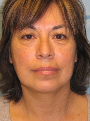 After-Facelift