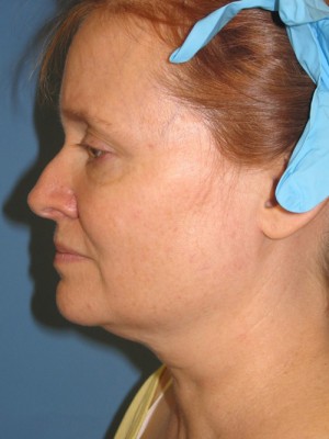Before-Facelift
