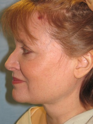 After-Facelift