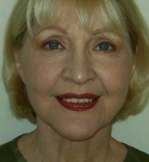 After-Facelift