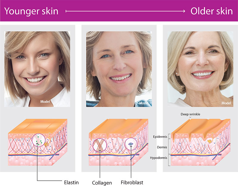 Profound® Skin Tightening in San Ramon, CA