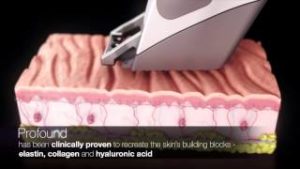 Profound® Skin Tightening in San Ramon, CA