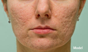 Acne Scar Clinic in San Ramon, CA