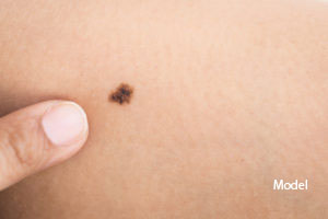 Malignant Melanoma in San Ramon, CA