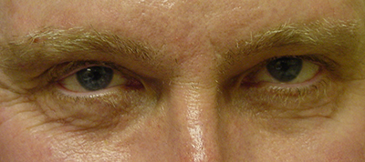 Cosmetic Procedures for Men in San Ramon, CA