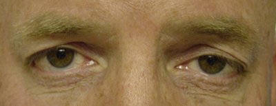 Cosmetic Procedures for Men Before and After Pictures San Ramon, CA