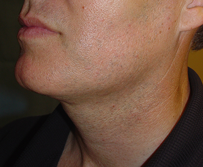 Cosmetic Procedures for Men in San Ramon, CA