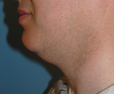 Cosmetic Procedures for Men in San Ramon, CA