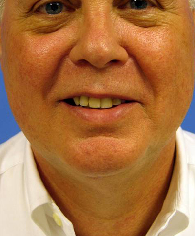 Cosmetic Procedures for Men in San Ramon, CA