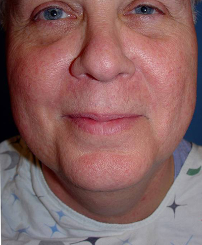 Cosmetic Procedures for Men in San Ramon, CA