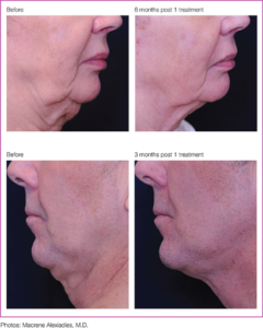 Profound® Skin Tightening Before and After Pictures San Ramon, CA