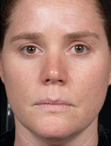 Veins and Hyperpigmentation Before and After Pictures San Ramon, CA