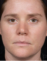 Veins and Hyperpigmentation Before and After Pictures San Ramon, CA