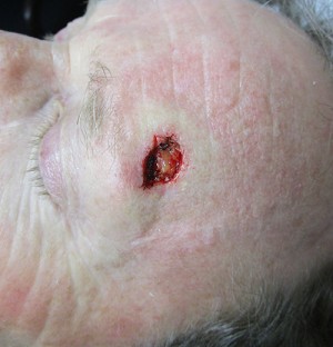 Before-Forehead Reconstruction