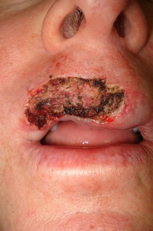 Before-Lip Reconstruction