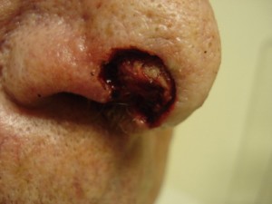 Before-Nose Reconstruction