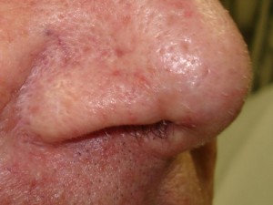 After-Nose Reconstruction