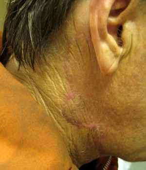 After-Neck Reconstruction