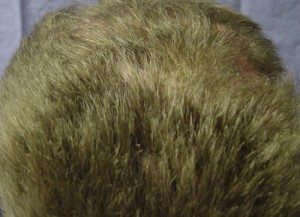 After-Scalp Reconstruction