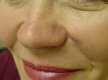 After-Nose Reconstruction