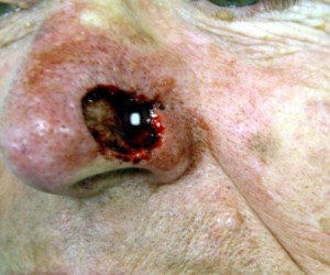 Before-Nose Reconstruction