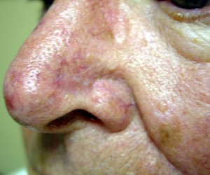 After-Nose Reconstruction