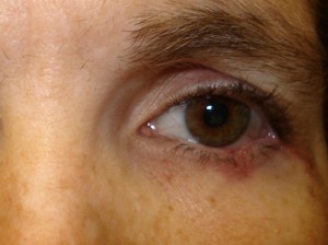 After-Eyelid Reconstruction