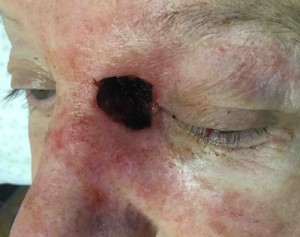 Before-Nose Reconstruction