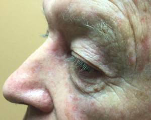 After-Nose Reconstruction