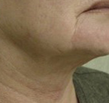 After-Neck Liposuction