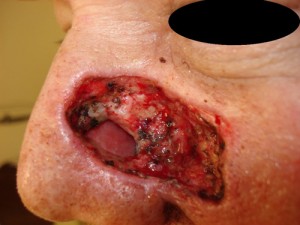 Before-Nose Reconstruction