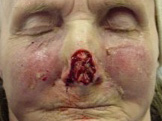 Before-Nose Reconstruction