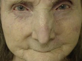 After-Nose Reconstruction