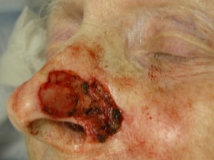 Before-Nose Reconstruction