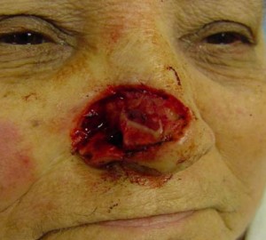 Before-Nose Reconstruction